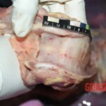 Larynx, measurements 2 Forensic autopsy with educational annotations