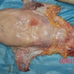 Stomach Forensic autopsy with educational annotations