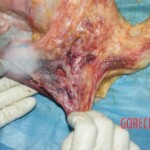 Part of the esophagus. Hemorrhage Forensic autopsy with educational annotations