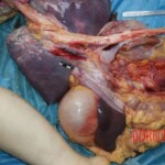 Lungs, liver, stomach. Measurement Forensic autopsy with educational annotations