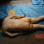 General view from the back Forensic autopsy with educational annotations