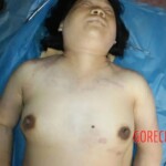 The hands of a corpse. Hematomas 2 Forensic autopsy with educational annotations