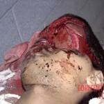 Fractured skull as result of traffic accident