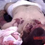 Fractured skull as result of traffic accident