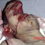 Fractured skull as result of traffic accident