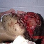 Fractured skull as result of traffic accident