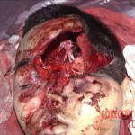 Fractured skull as result of traffic accident