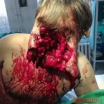 Guy survived suicide attempt with shotgun