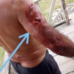 Man sought medical treatment after alligator attack