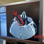 Splinter impaled eye, almost hitting brain