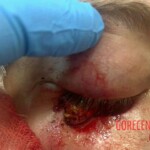 Splinter impaled eye, almost hitting brain