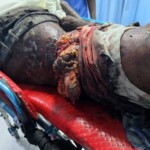 Two Somalis suffered serious injuries in traffic accident