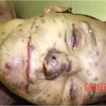 Autopsy of HIV-positive and drug-addicted man