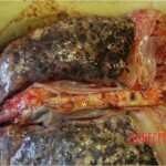 Autopsy of HIV-positive and drug-addicted man