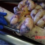 Autopsy of HIV-positive and drug-addicted man