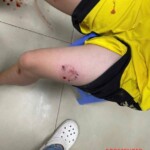 Boy attacked and bitten by stray dog