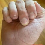 Consequences of copperhead bite to finger