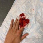 Dude cut off tip of his finger with sliding door