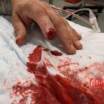 Dude cut off tip of his finger with sliding door