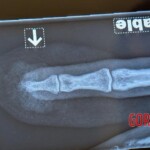 Dude cut off tip of his finger with sliding door