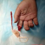Girl tore off her finger while climbing over fence