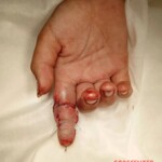 Girl tore off her finger while climbing over fence
