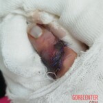 Girl tore off her finger while climbing over fence