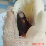 Girl tore off her finger while climbing over fence
