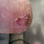 Minor foot injury led to amputation