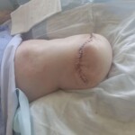 Minor foot injury led to amputation