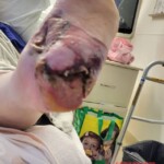 Minor foot injury led to amputation