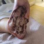 Minor foot injury led to amputation