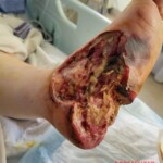 Minor foot injury led to amputation