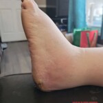 Minor foot injury led to amputation