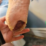 Minor foot injury led to amputation