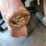 Minor foot injury led to amputation