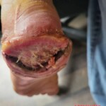 Minor foot injury led to amputation