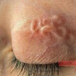 Parasite in eye after mosquito bite