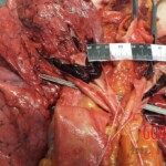 Woman suddenly died of cardiac arrest caused by venous thrombosis