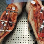 Woman suddenly died of cardiac arrest caused by venous thrombosis