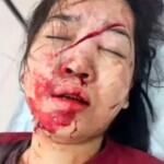 Young Vietnamese woman slashed in face with sickle