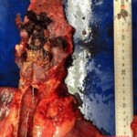 Autopsy of Japanese man who choked on sushi roll