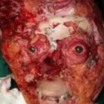 Breathtaking facial reconstruction of woman after car accident