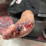 His dog ate his big toe while he was sleeping