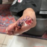 His dog ate his big toe while he was sleeping