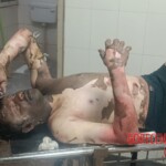Indian guy suffered severe burns from suicide attempt