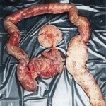 Young woman died from constipation