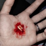 Dude ripped out his own tooth at home