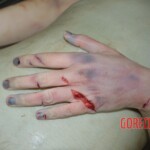 Examination and autopsy of female victim of machete attack