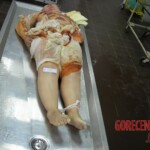 Female fire victim in morgue